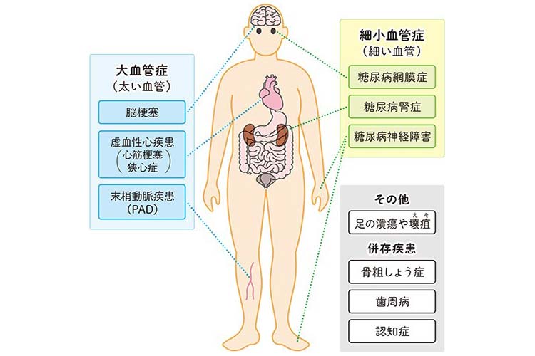 糖尿病の合併症